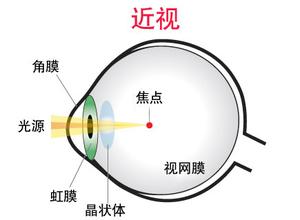 戴眼鏡會讓眼睛近視度數加深？