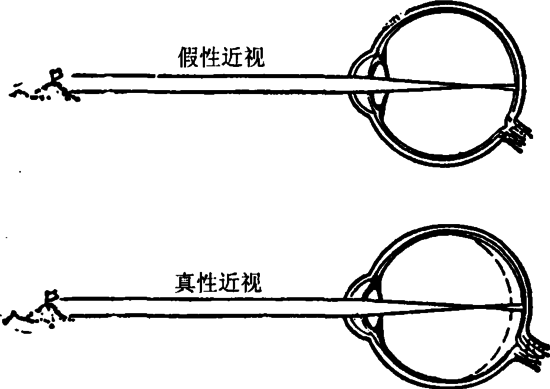 戴眼鏡會讓眼睛近視度數加深？