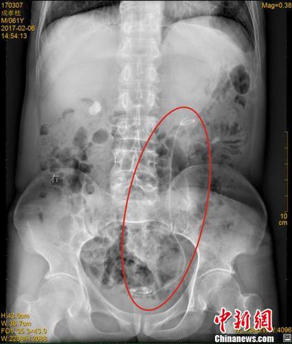 四川一男子體內藏30厘米醫用導管七年渾然不知（圖）