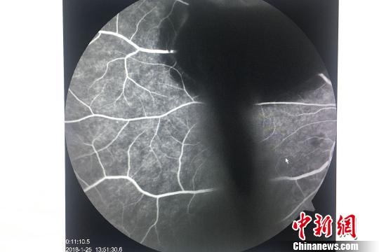 飲酒后劇烈嘔吐致視力猛降小伙患“瓦爾薩爾瓦視網膜病變”