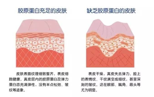 注射膠原蛋白真的能改善臉部皺紋？