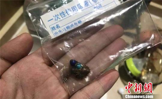 從患者體內取出的磁力珠，其中有3顆已經被腸液腐蝕發黑 浙江大學明州醫院供圖