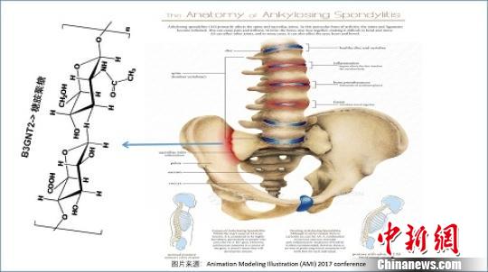 中國(guó)科學(xué)家等揭示漢族人群強(qiáng)直性脊柱炎關(guān)聯(lián)基因